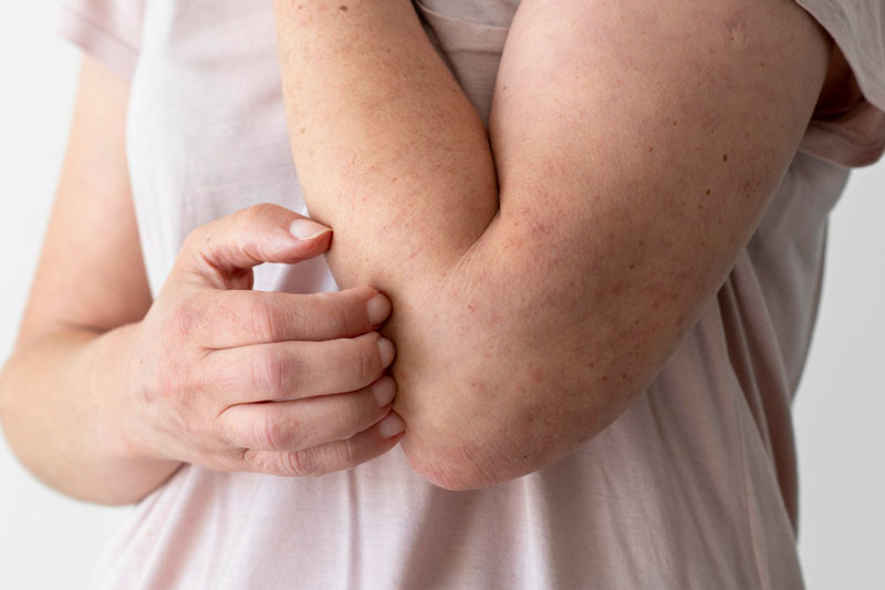 dermatitis ojos